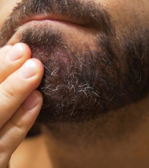 forfora nella barba qual è la causa