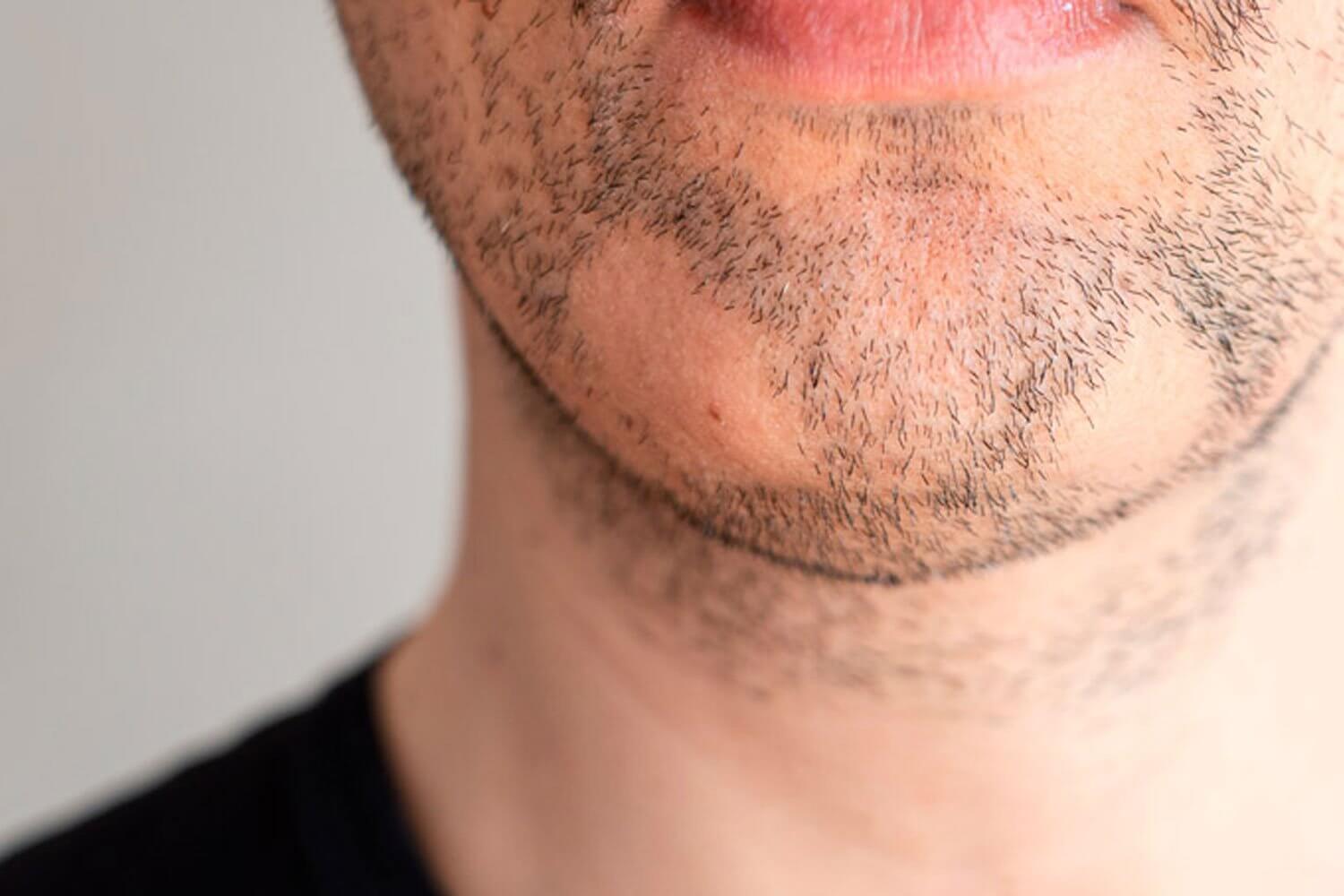 Alopecia della barba le cause principali