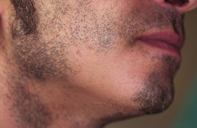 alopecia della barba quali sono i sintomi più frequenti