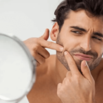 Cos’è la follicolite della barba e come curarla
