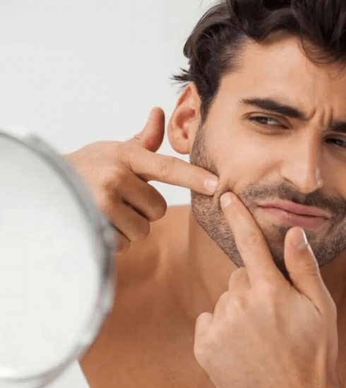 Cos’è la follicolite della barba e come curarla